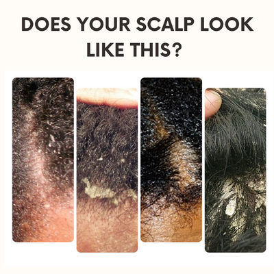Introducing Sunny In Denbigh long awaited Scalp Bundle!!  If you suffer from any scalp issues including Seborrheic Dermatitis, Dandruff, Psoriasis, excessive sebum or build up this is the bundle for you. Works on children and adults.  